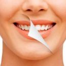 Отбеливание зубов: стоматолог поделился советами