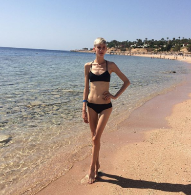 Победительница «Супермодель по-украински» рассказала об анорексии