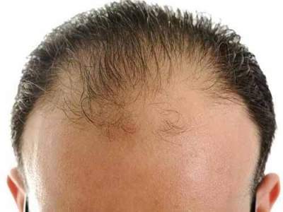 Медики подсказали, как бороться с облысением